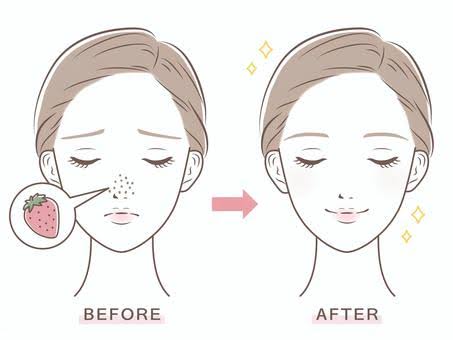 毛穴ケア方法：いちご鼻・黒ずみ洗顔で毛穴レス肌へ